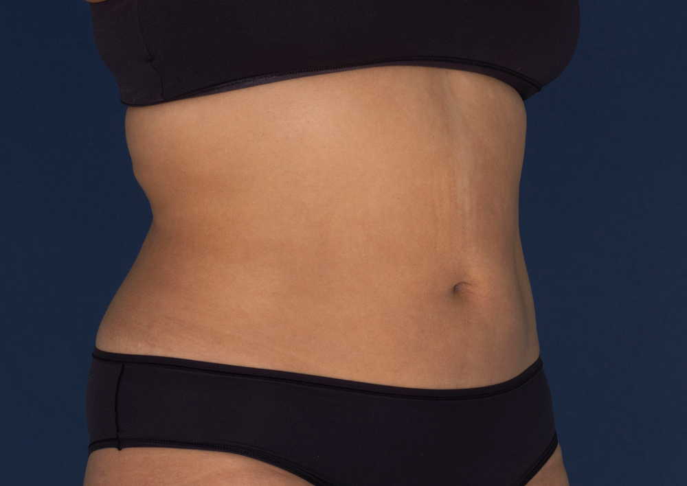 Abdomen and Love Handles after CoolSculpting