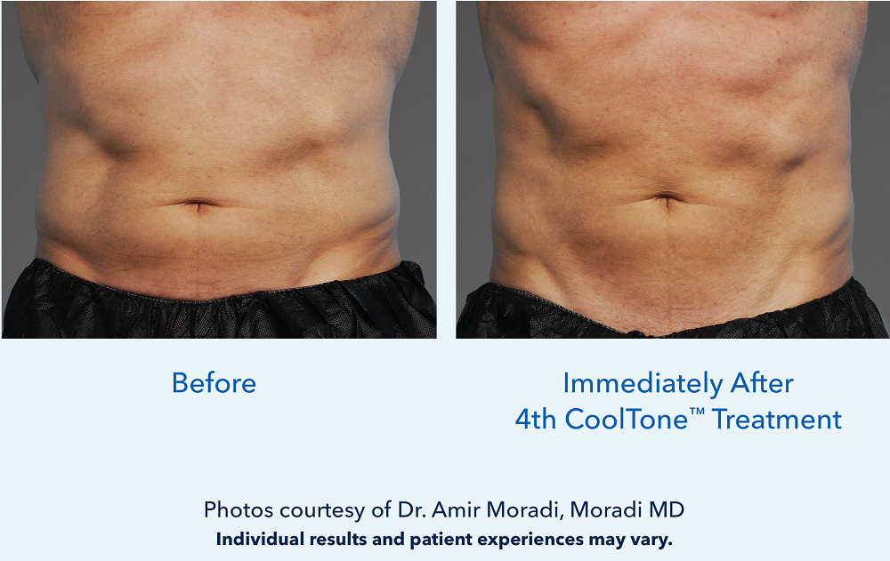 before and after CoolTone treatment on abdomen