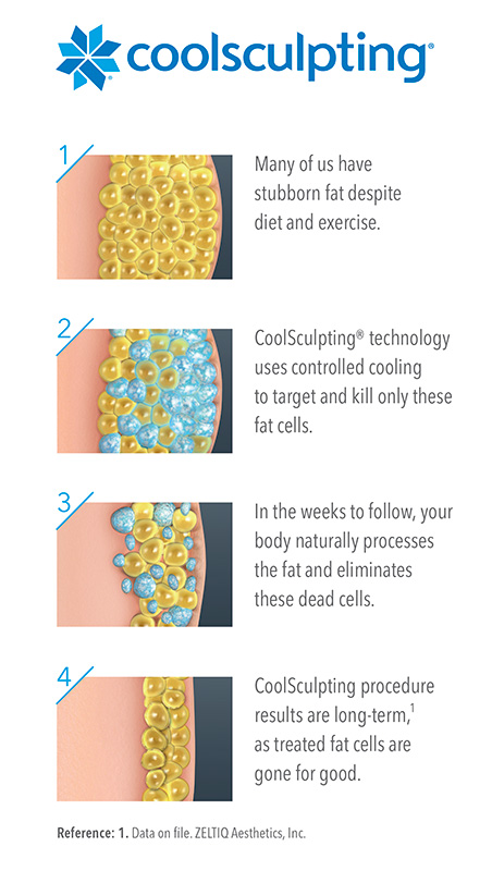 Euro Med Spa offers CoolSculpting fat-reduction treatments in Chattanooga and Cleveland, TN