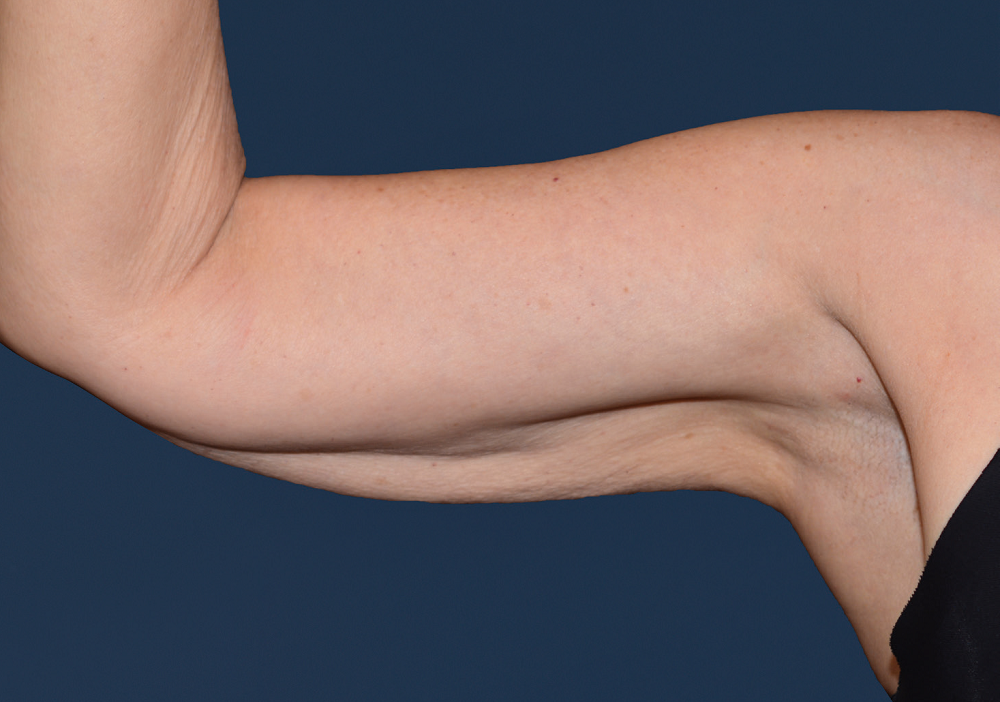 upper arms after CoolSculpting